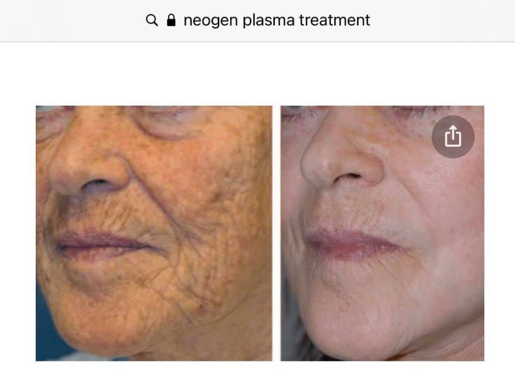 NeoGen PSR at ThrIVe Wheeling Builds Collagen and Removes Pigmentation, Reverses Signs of Aging