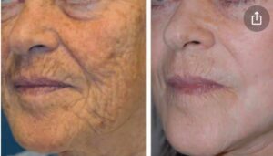 NeoGen PSR at ThrIVe Wheeling Builds Collagen and Removes Pigmentation, Reverses Signs of Aging