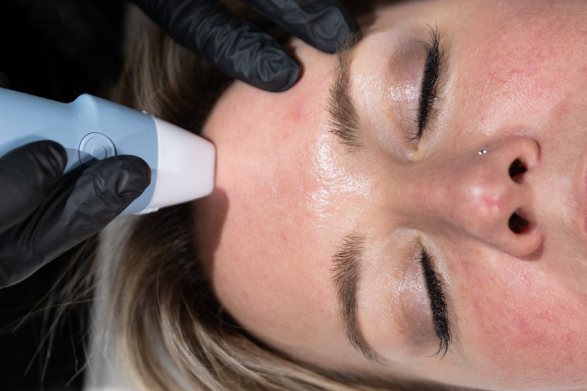 A close-up of the upper portion of a client's face as she receives her skin tightening near Weirton treatment. Her eyes are closed as she relaxes, her provider gently guiding the RF device over her forehead to treat skin laxity.