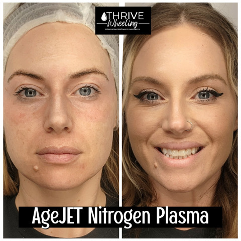 A before-and-after picture of a patient post-skin resurfacing in Wheeling, WV, using AgeJET. The patient visibly has smoother skin, with less discoloration and pigmentation.