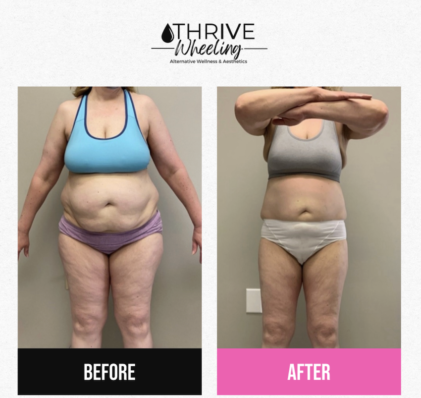 A before-and-after image of a patient's success after her body sculpting near Washington County, PA. She has a noticeable reduction in belly fat, as well as overall thinning in the arms and legs.